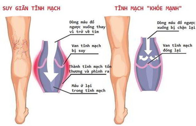 Giãn tĩnh mạch chân