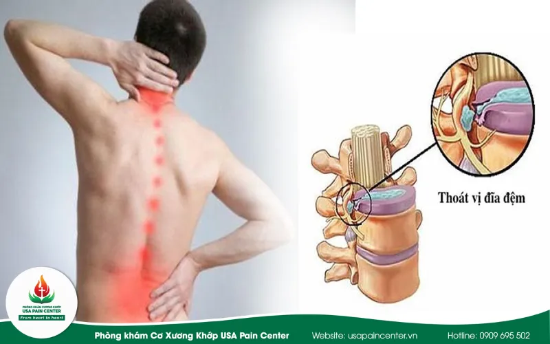 thoát vị đĩa đệm