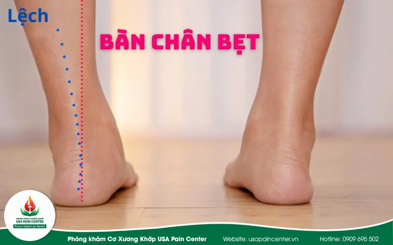 Bàn chân bẹt