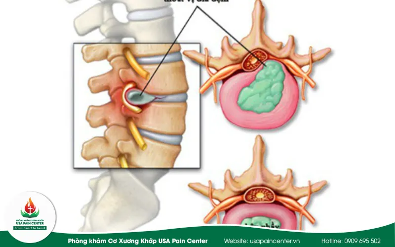 điều trị bệnh đau lưng bằng thuốc
