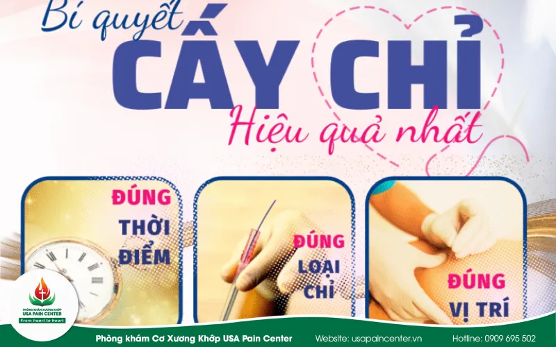 Phương pháp cấy chỉ điều trị đau lưng