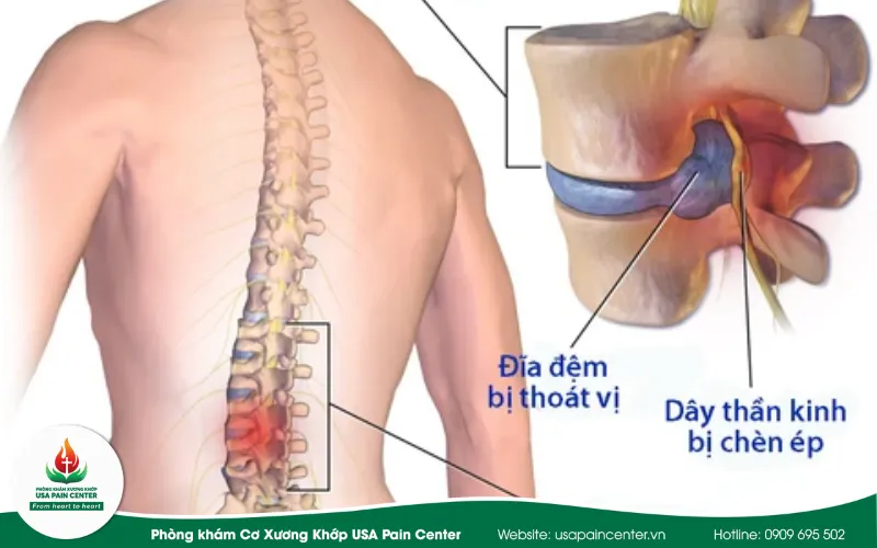 thoát vị đĩa đệm, bệnh thường gặp của cột sống