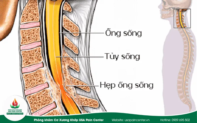 hẹp ống sống