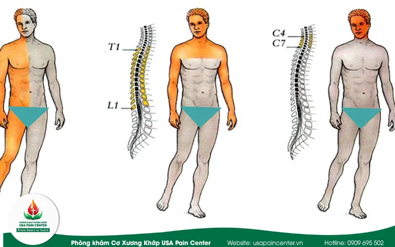 hội chứng liệt nữa người và cách điều trị