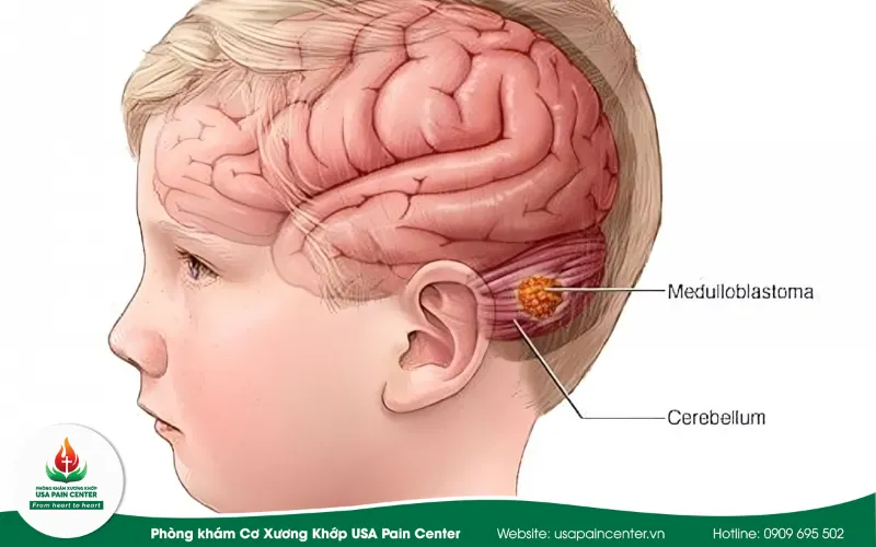 bệnh liệt và cách điều trị