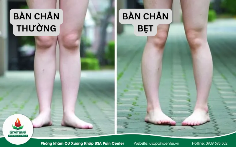 Đau lưng dưới và đầu gối do bàn chân bẹt