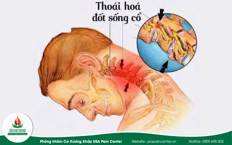 thoái hóa khớp gây đau cổ vai gáy