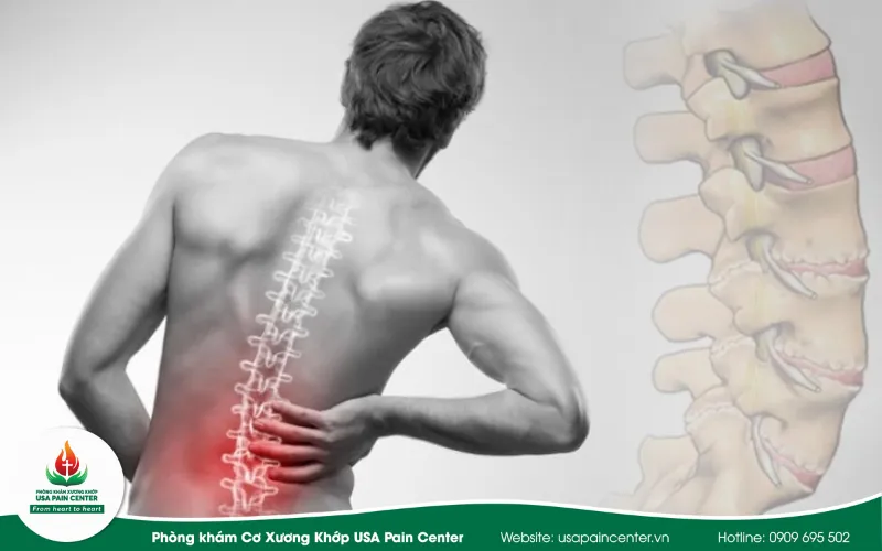 ĐAU LƯNG: NGUYÊN NHÂN, TRIỆU CHỨNG VÀ CÁCH CHẨN ĐOÁN