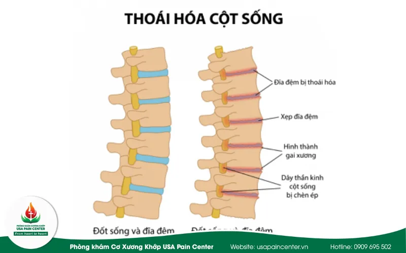 thoái hóa cột sống lưng