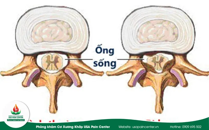 hẹp ống sống