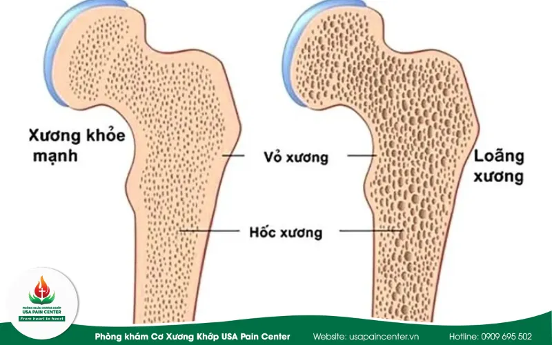 nguyên nhân và triệu chứng loãng xương