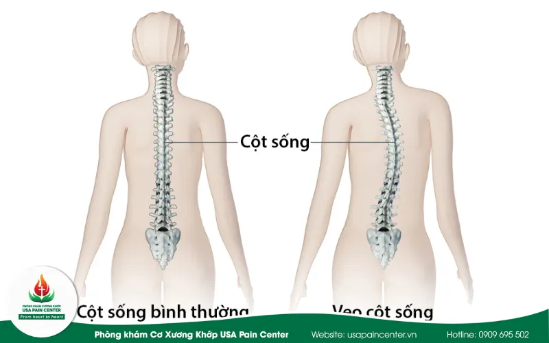 congg vẹo cột sống