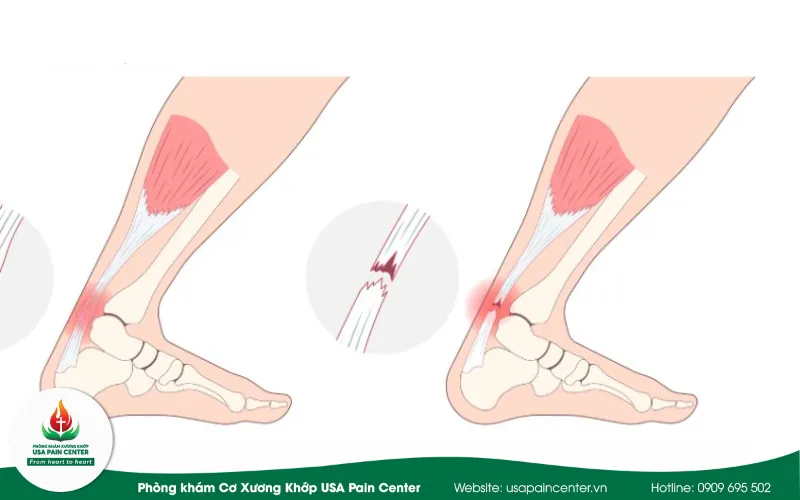 chấn thương cổ chân