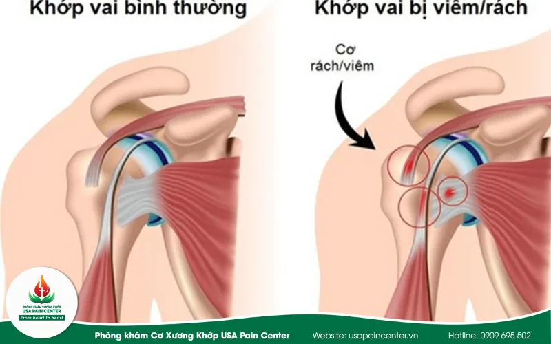 chấn thuowgn vai khi chơi golf