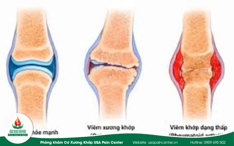 Các bệnh viêm khớp