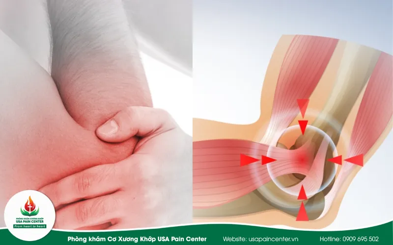 Viêm gân thường gặp ở các vị trí vận động