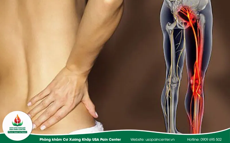Đau thần kinh tọa là gì