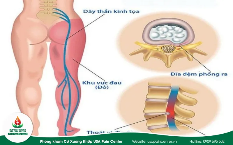 dây thần kinh tọa