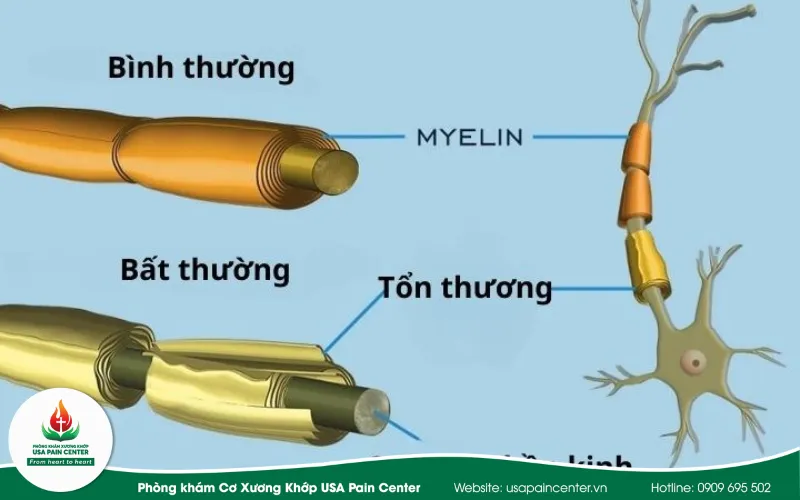 Bệnh Guillain-Barré 