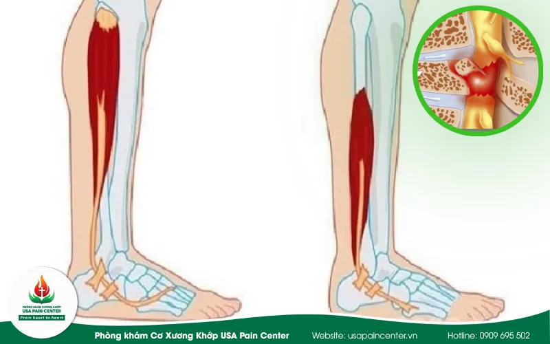 Bệnh xơ cứng teo cơ một bên (ALS)