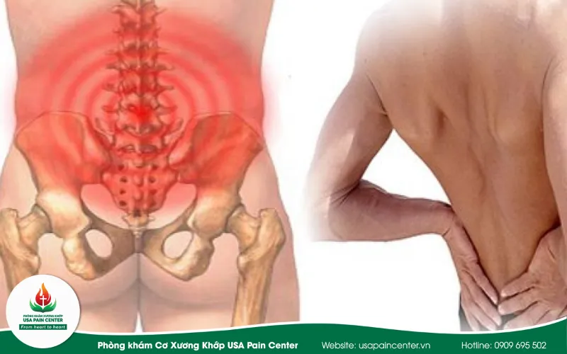 dấu hiệu đua nhức ở các vùng cột sống của bệnh liệt