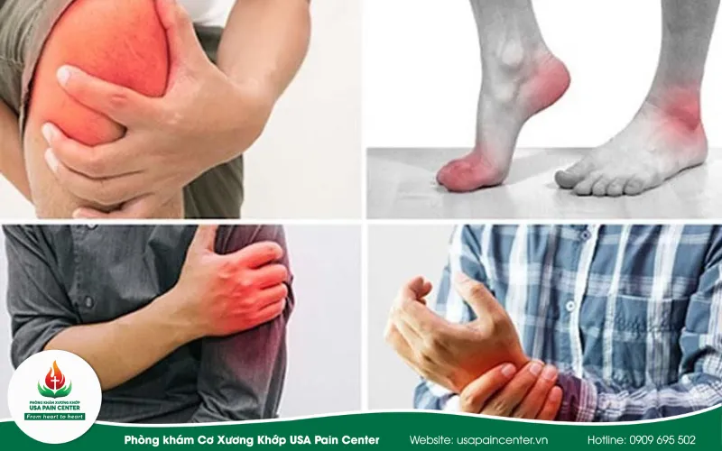 Các bệnh liên quan Cơ xương khớp