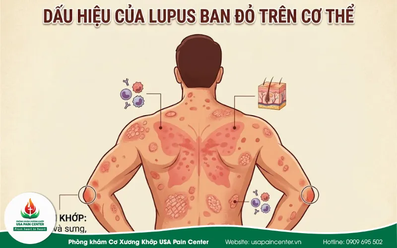 bệnh lusban đỏ do liên quan tới cơ xương khớp