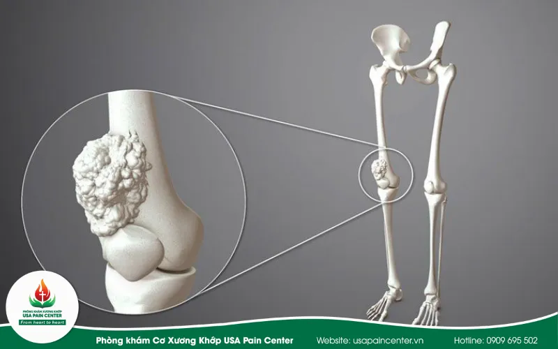 cá bệnh u bứu xương khớp