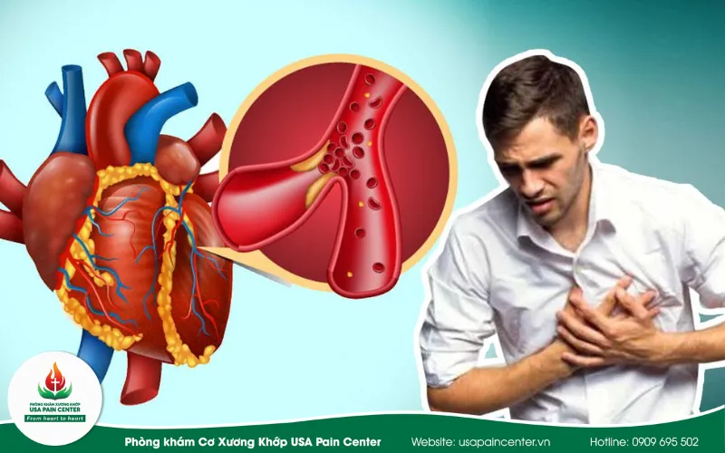xơ vữa động mạch do vấn đề liên quan tới xương khớp