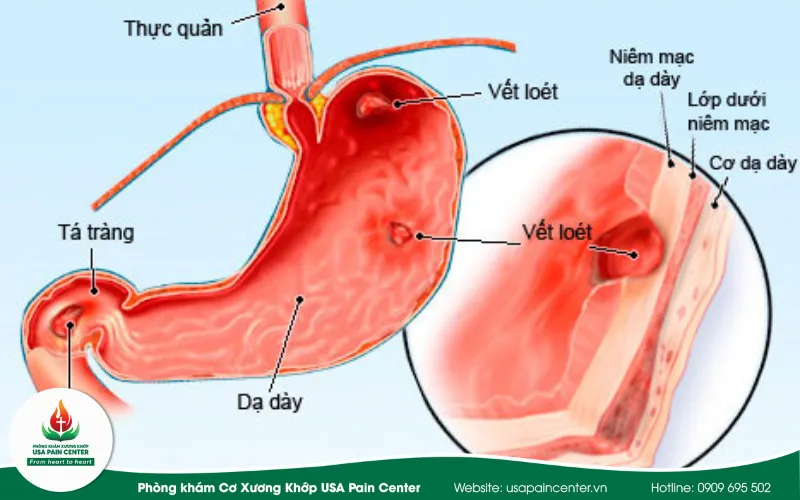 tác hại của việc lạm dụng thuốc giảm đau