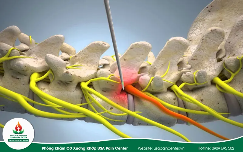 3 NGUYÊN NHÂN KHIẾN VIỆC TRỊ LIỆU THẦN KINH CỘT SỐNG KÉM HIỆU QUẢ