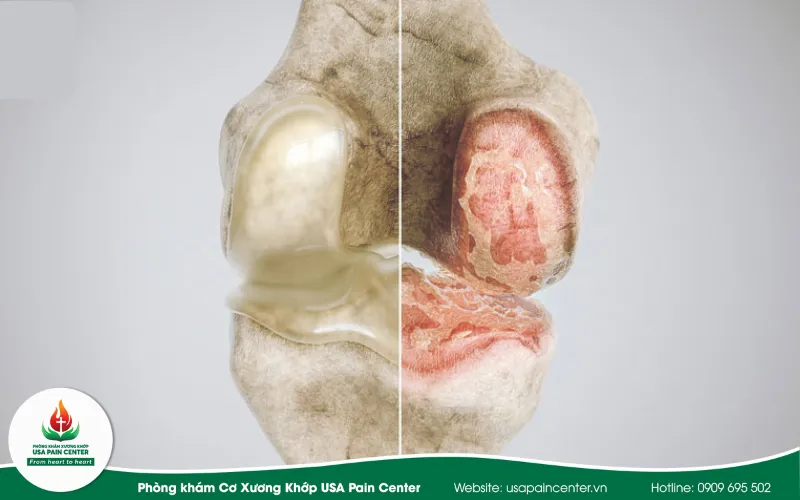 Thoái hóa khớp gối