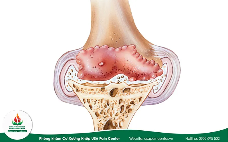 Gai khớp gối có mài được không?