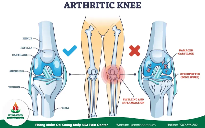 Gai khớp gối (Knee Osteophytes)