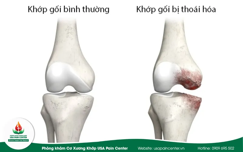 Nhưng biểu hiện lâm sàng bệnh gai khớp gối