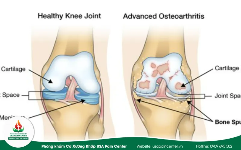 Một số nguyên nhân dẫn tới gai khớp gối