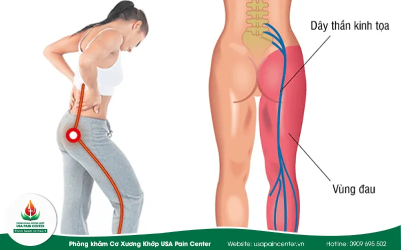 Đau Thần Kinh Tọa: Triệu chứng chi tiết và phương pháp điều trị hiệu quả