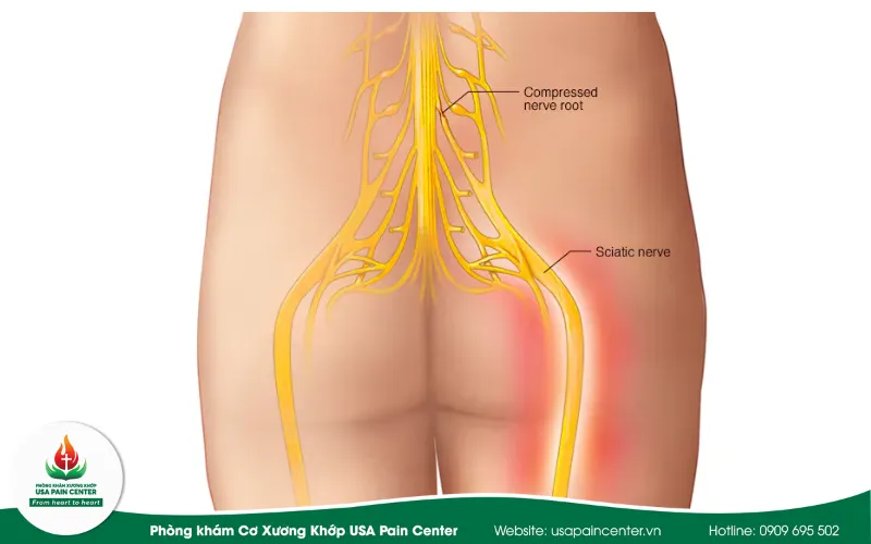 Triệu chứng đau thần kinh tọa