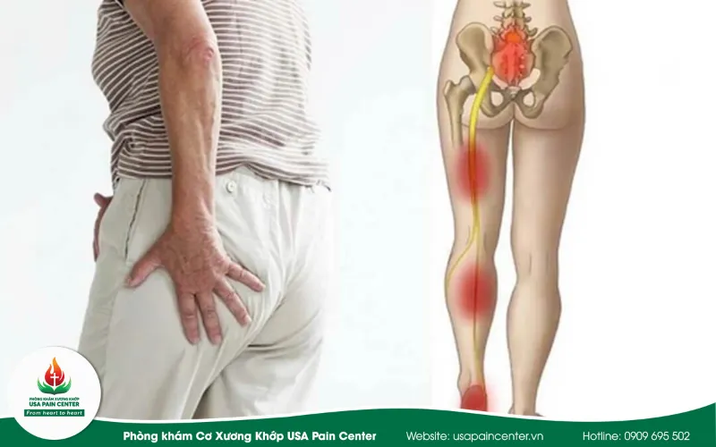 Ở giai đoạn nặng người bệnh đau dữ dội, mất cảm giác vùng mông, chân hoặc bàn chân