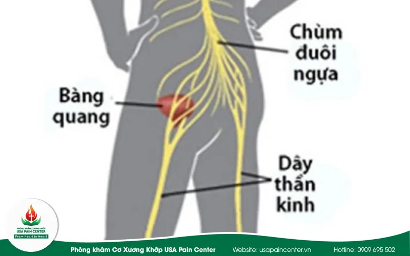 hội chứng chùm đuôi ngựa biến chứng đau thần kinh tọa