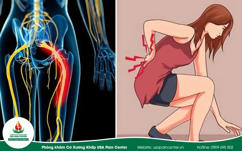 biến chứng đau thần kinh tọa