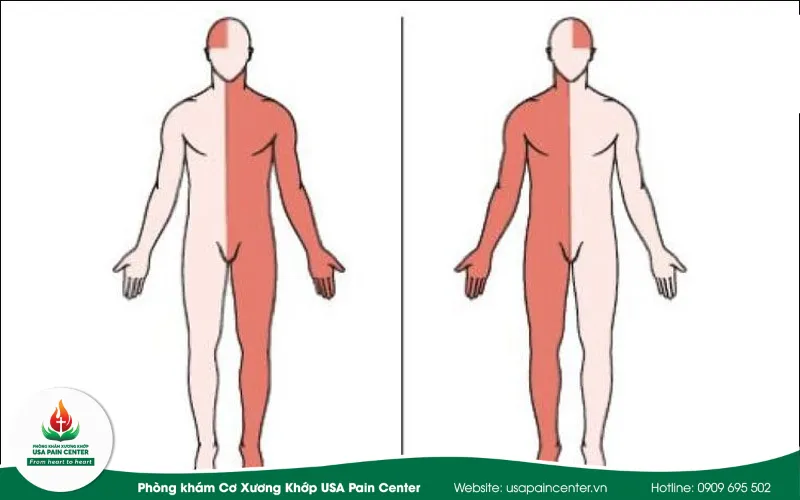 Liệt nữa người do tổn thương não bộ