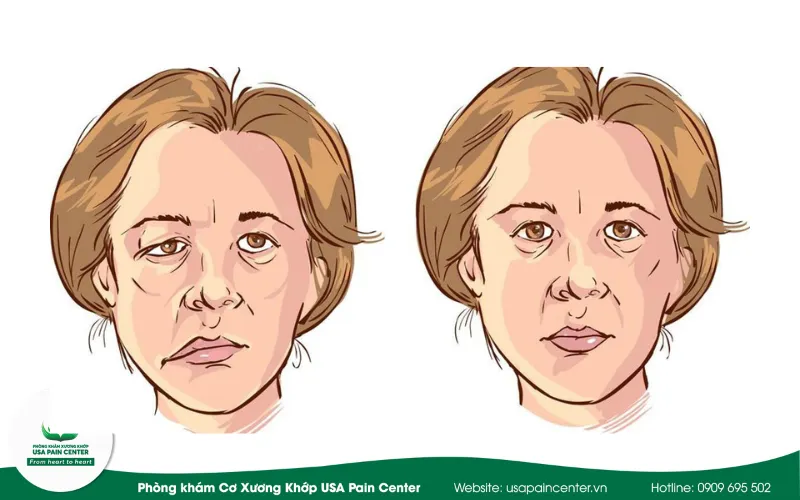 bệnh liệt mặt ngoại biên