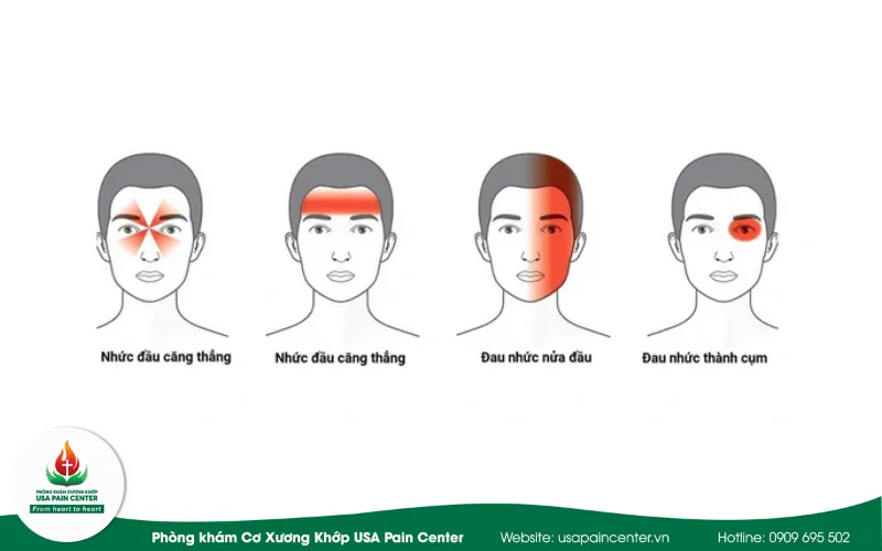 các dạng đau đầu