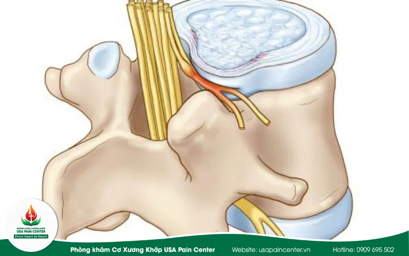 đau sáu phẫu thuật do dây thần kinh bị chèn ép
