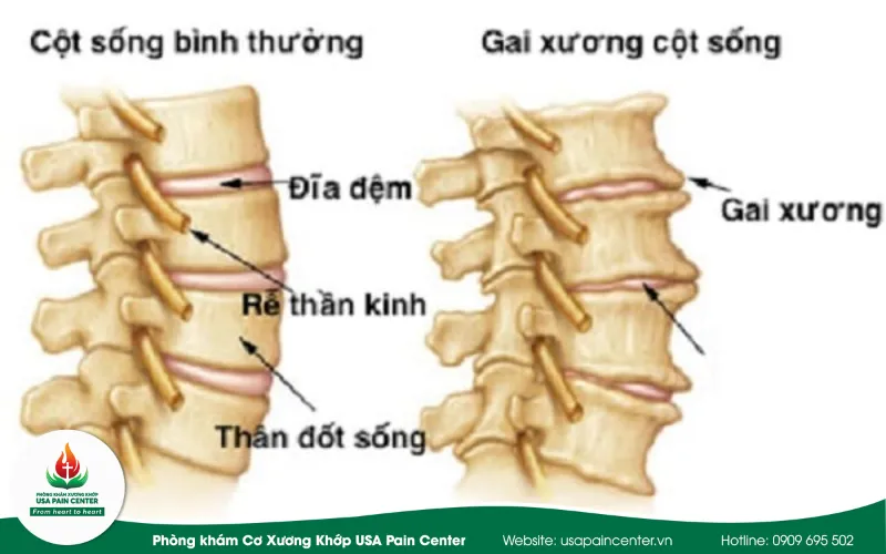 Gai cột sống