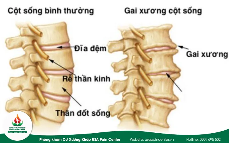 gai cột sống thắt lưng
