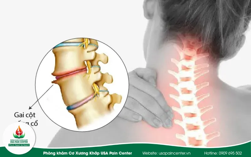 gai cột sống cổ