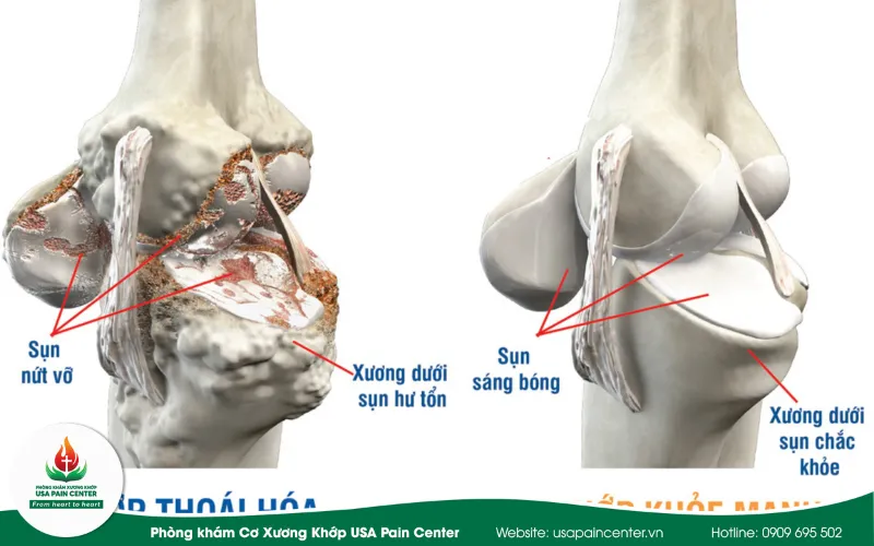 triệu chứng của bệnh thoái hóa khớp