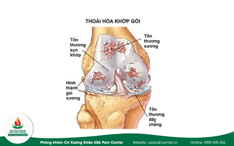 thoái hóa khớp gối nặng